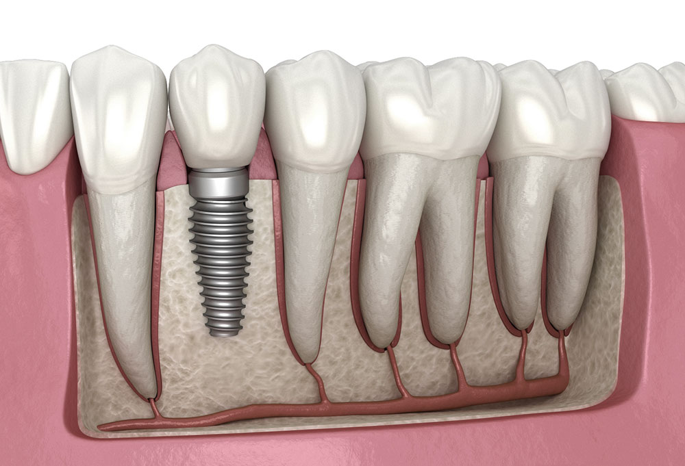 Local Dental Implants Online Blog, Dental Implant Placement Discussion, dental implants info